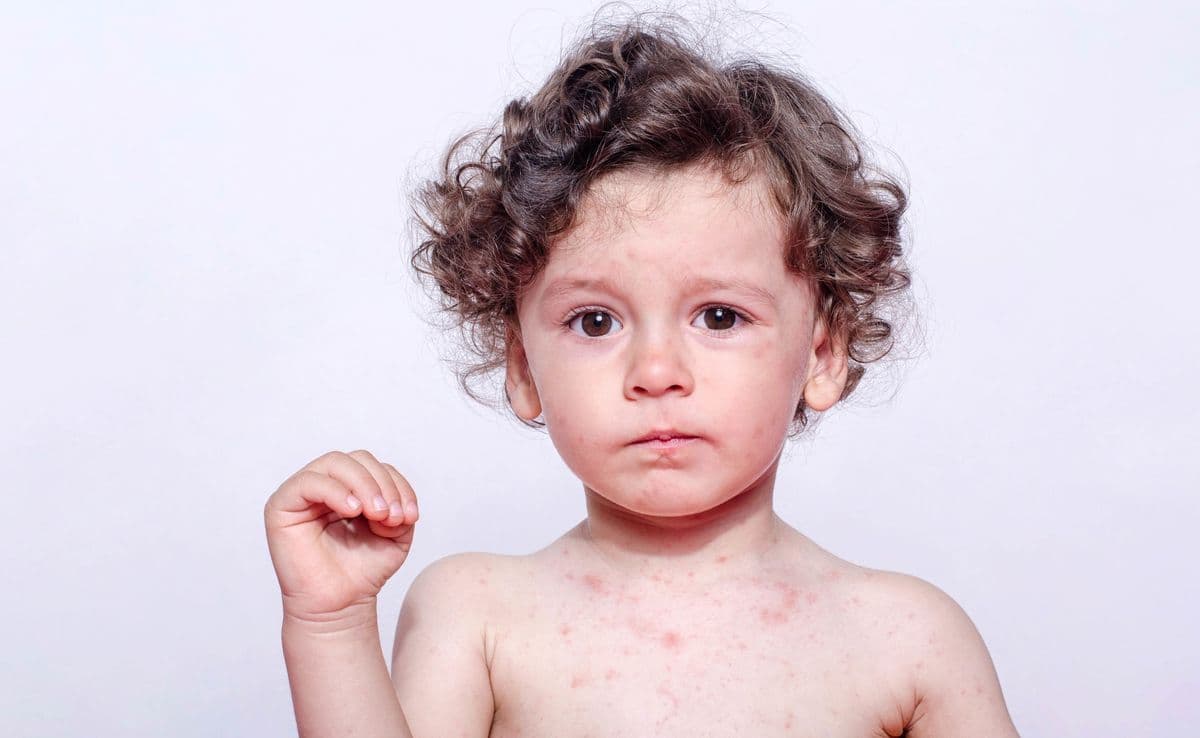 3 common questions about measles